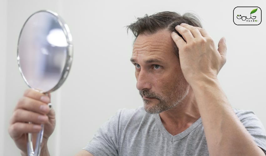تقویت موی جلوی سر مردان + علل ریزش و درمان